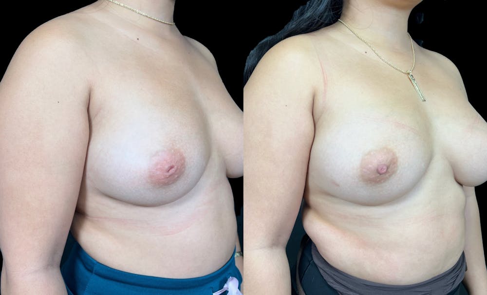 Inverted Nipple Correction Before & After Gallery - Patient 338016 - Image 3