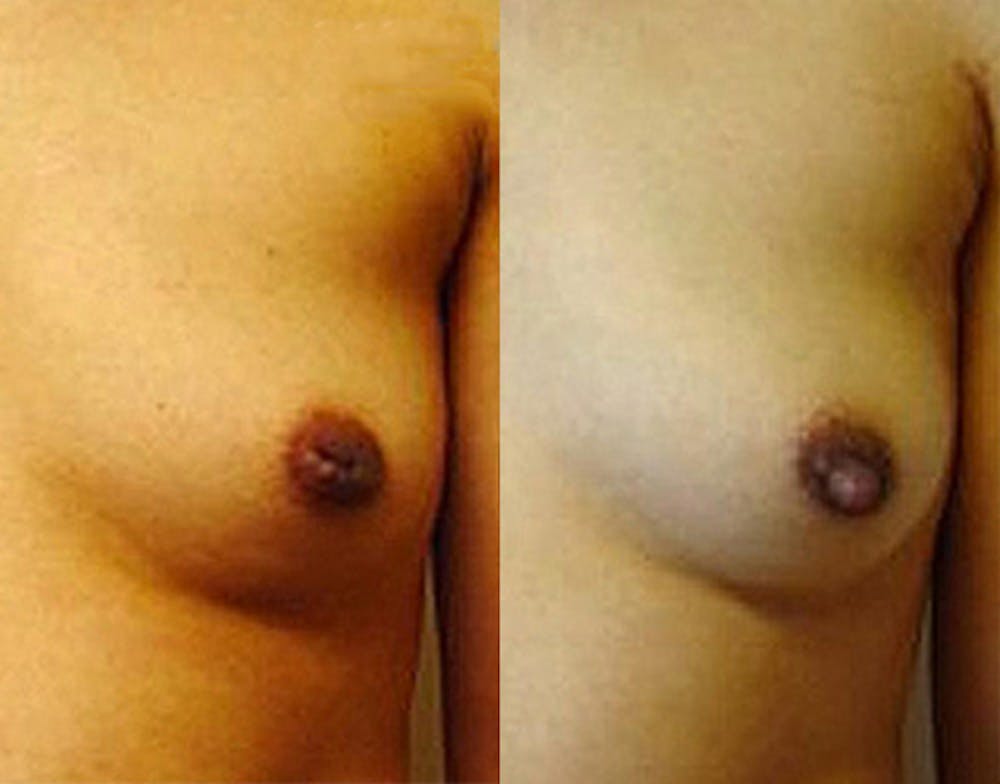 Inverted Nipple Correction Before & After Gallery - Patient 38290684 - Image 1