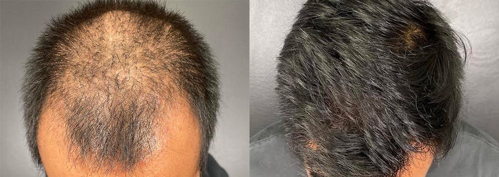 Hair Restoration Before & After Gallery - Patient 285198 - Image 1