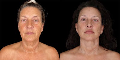 Facelift Before & After Gallery - Patient 376385 - Image 1