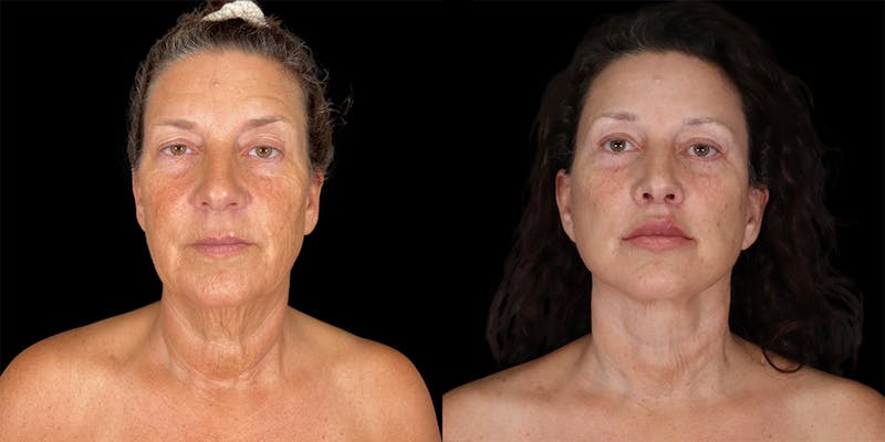 Before and after Facelift surgery in Honolulu with Dr. Shim Ching