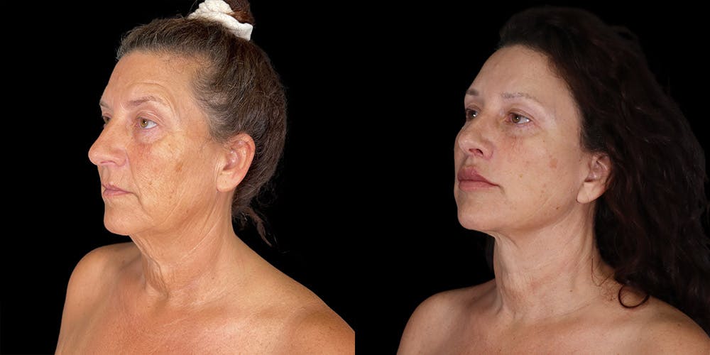 Facelift Before & After Gallery - Patient 376385 - Image 2
