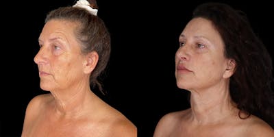 Facelift Before & After Gallery - Patient 376385 - Image 2