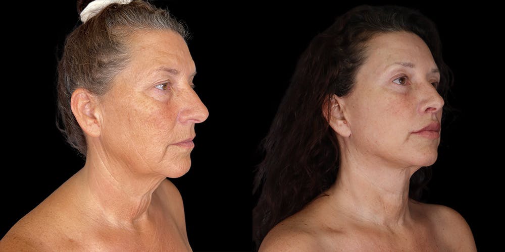 Necklift Before & After Gallery - Patient 237608 - Image 2
