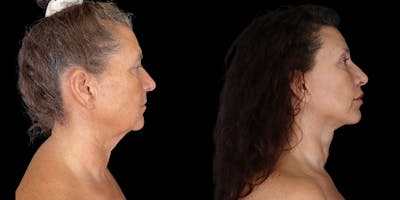 Lip Lift Before & After Gallery - Patient 292471 - Image 4