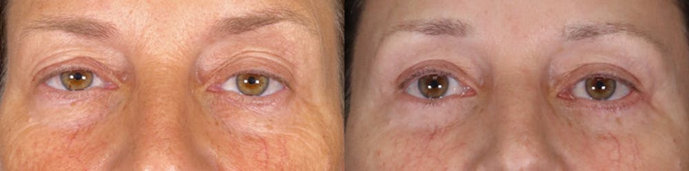 Eyelid Surgery Before & After Gallery - Patient 314325 - Image 1