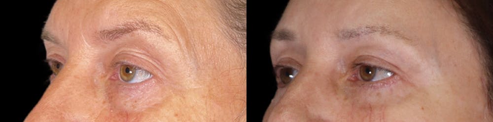 Eyelid Surgery Before & After Gallery - Patient 314325 - Image 2