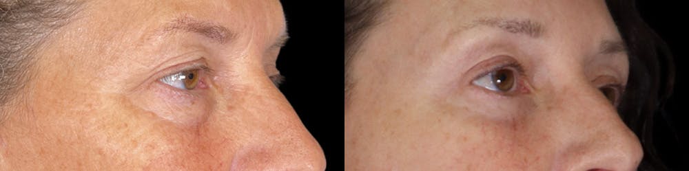 Eyelid Surgery Before & After Gallery - Patient 314325 - Image 3