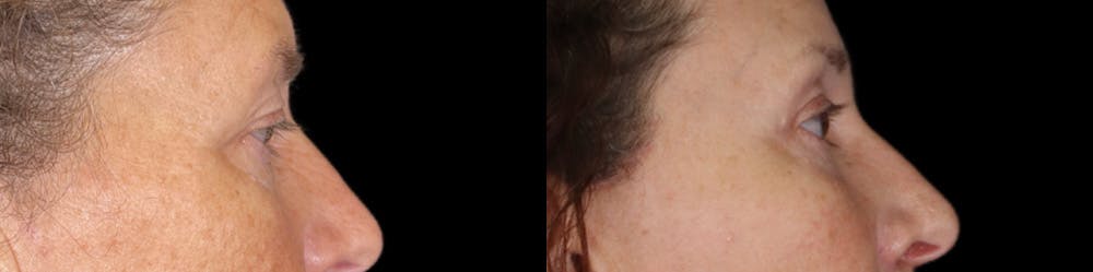 Eyelid Surgery Before & After Gallery - Patient 314325 - Image 4
