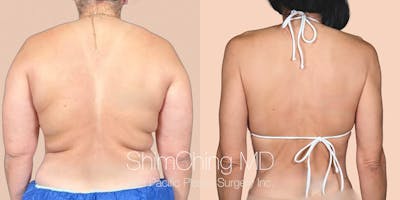 Semaglutide Before & After Gallery - Patient 199678 - Image 1