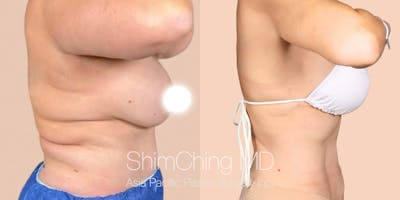 Semaglutide Before & After Gallery - Patient 276113 - Image 2