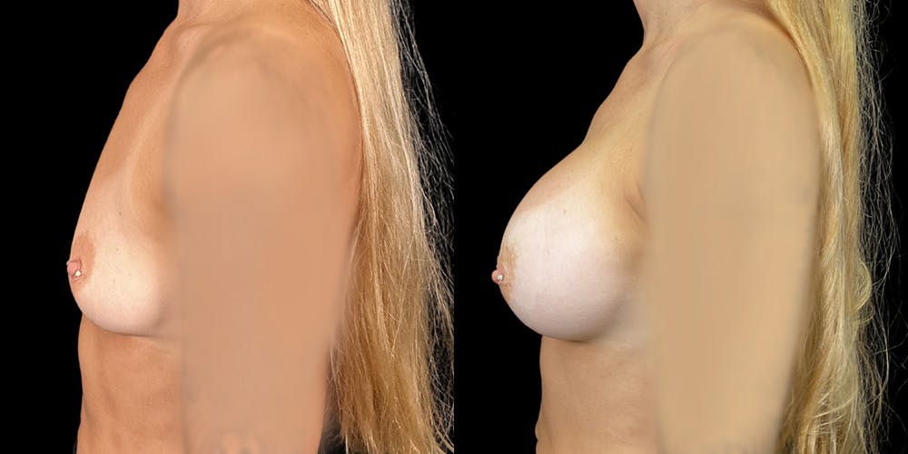 Breast Augmentation Before & After Gallery - Patient 399406 - Image 3