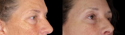 Browlift Before & After Gallery - Patient 170404 - Image 1