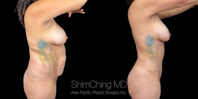 Laser Liposuction Before & After Gallery - Patient 662828 - Image 2