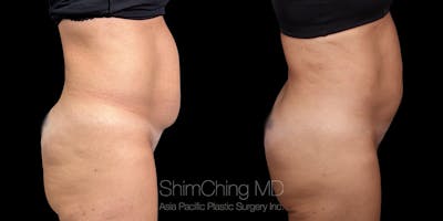 Laser Liposuction Before & After Gallery - Patient 392788 - Image 4