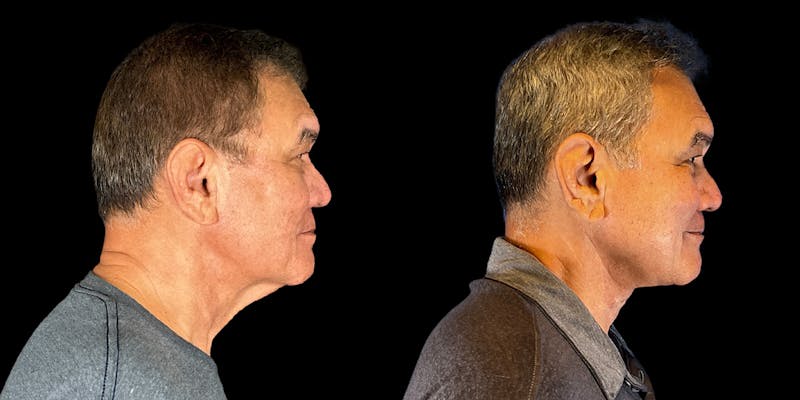 Neck Lift