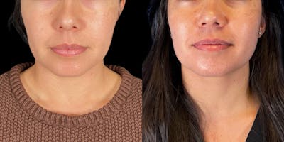 Buccal Fat Removal Before & After Gallery - Patient 390530 - Image 1