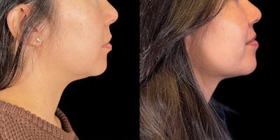 Laser Liposuction Before & After Gallery - Patient 178139 - Image 1