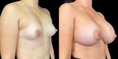 Breast Augmentation Before & After Gallery - Patient 269148 - Image 2