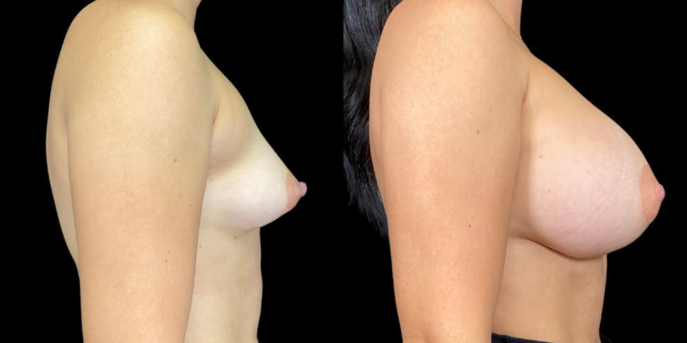 Breast Augmentation Before & After Gallery - Patient 269148 - Image 3
