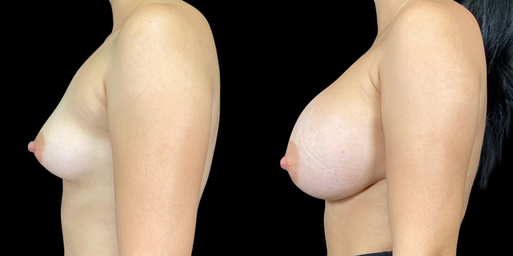 Breast Augmentation Before & After Gallery - Patient 269148 - Image 4