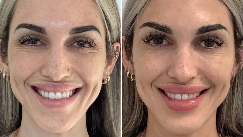 Lip fillers before & after