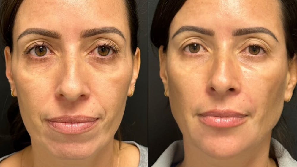 BOTOX/Daxxify Before & After Gallery - Patient 373790 - Image 1