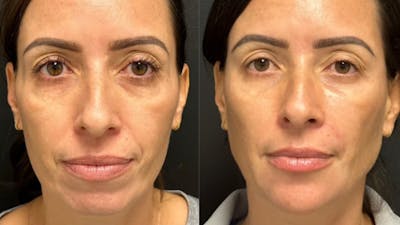 BOTOX/Daxxify Before & After Gallery - Patient 373790 - Image 1