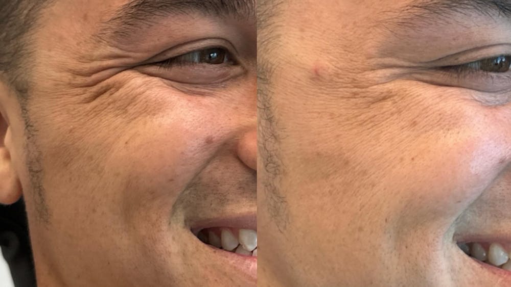 BOTOX/Daxxify Before & After Gallery - Patient 133194 - Image 1