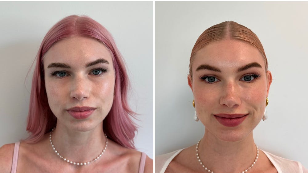 BOTOX/Daxxify Before & After Gallery - Patient 291705 - Image 1