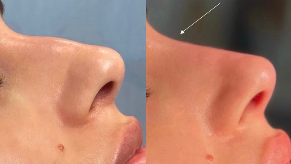 Non-Surgical Rhinoplasty Before & After Gallery - Patient 314298 - Image 1