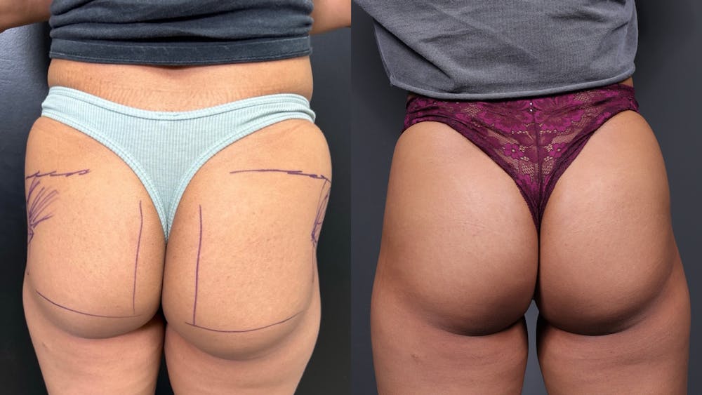 Non-Surgical BBL Before & After Gallery - Patient 250794 - Image 1
