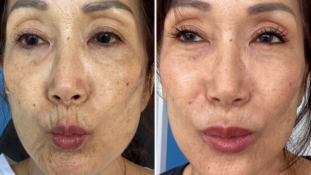 BOTOX/Daxxify Before & After Gallery - Patient 858801 - Image 2