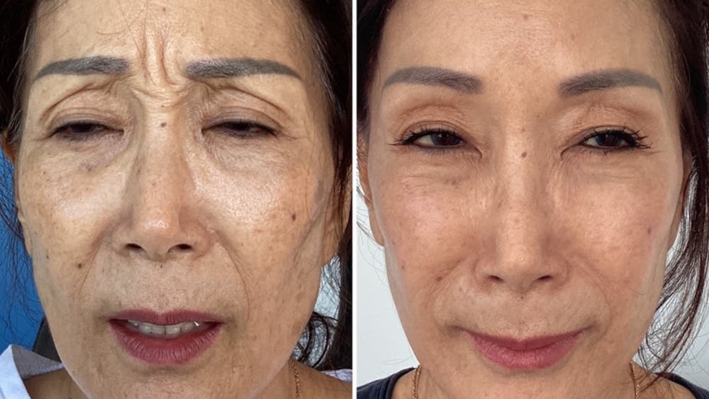 BOTOX/Daxxify Before & After Gallery - Patient 858801 - Image 1