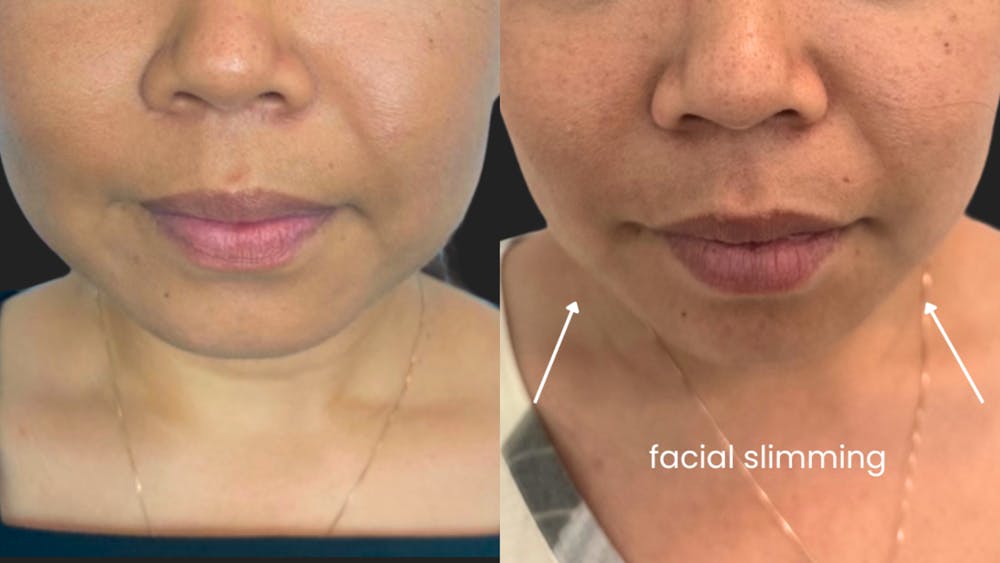 Kybella Before & After Gallery - Patient 427194 - Image 1