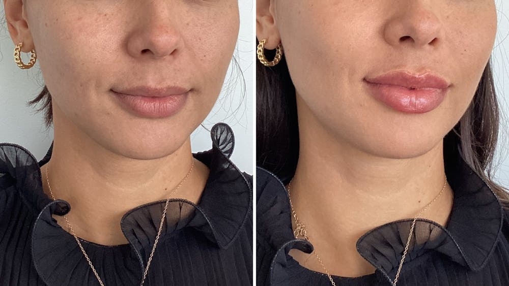 Lip Filler Before & After Gallery - Patient 415753 - Image 1