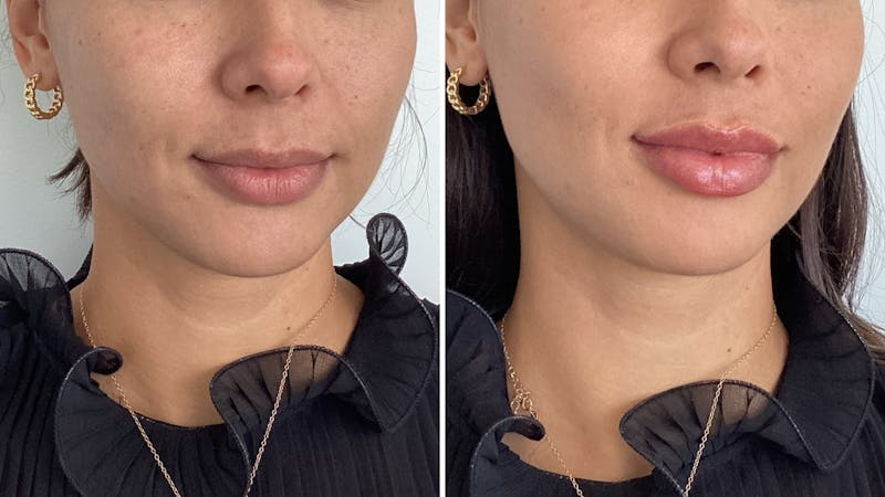 Lip fillers before & after