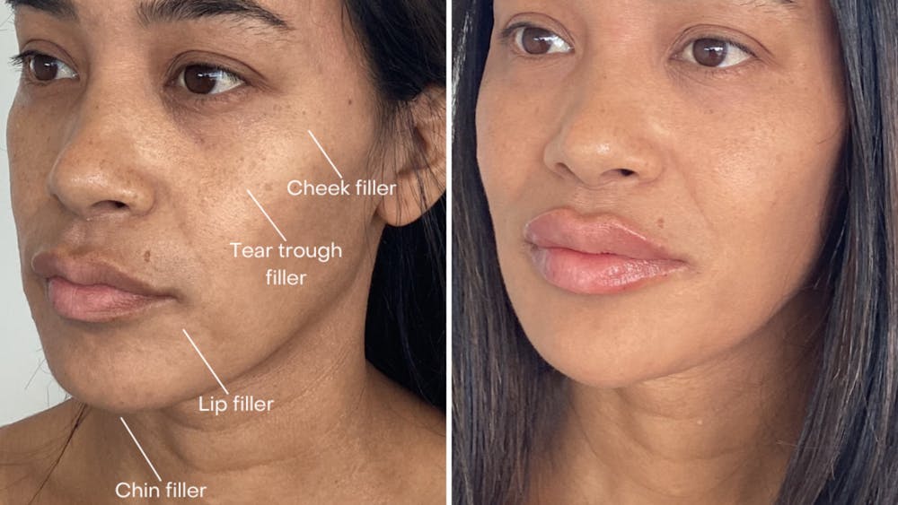 Facial Balancing Before & After Gallery - Patient 145361 - Image 1