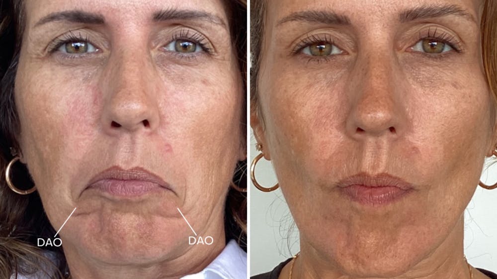 BOTOX/Daxxify Before & After Gallery - Patient 304010 - Image 1