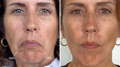 BOTOX/Daxxify Before & After Gallery - Patient 304010 - Image 1