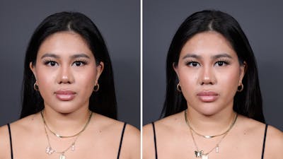 BOTOX/Daxxify Before & After Gallery - Patient 171304 - Image 1