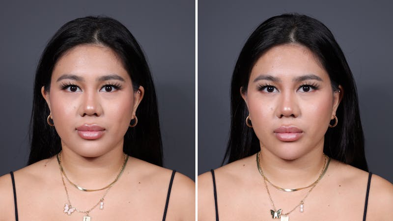 Daxxify before & after