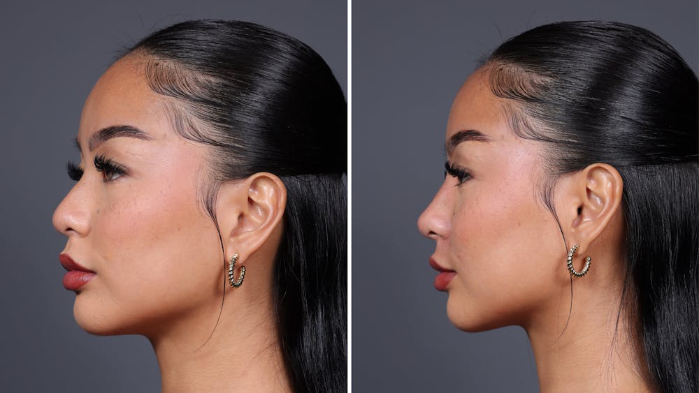 Non-Surgical Rhinoplasty Before & After Gallery - Patient 226298 - Image 1