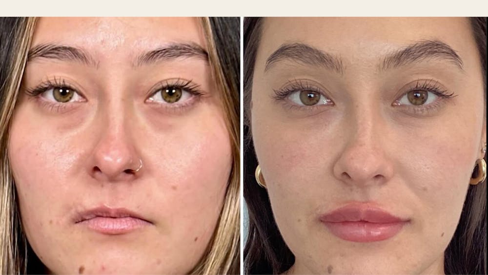 Facial Balancing Before & After Gallery - Patient 484822 - Image 1