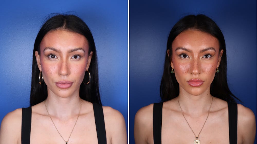 Dermal Fillers Before & After Gallery - Patient 241629 - Image 1