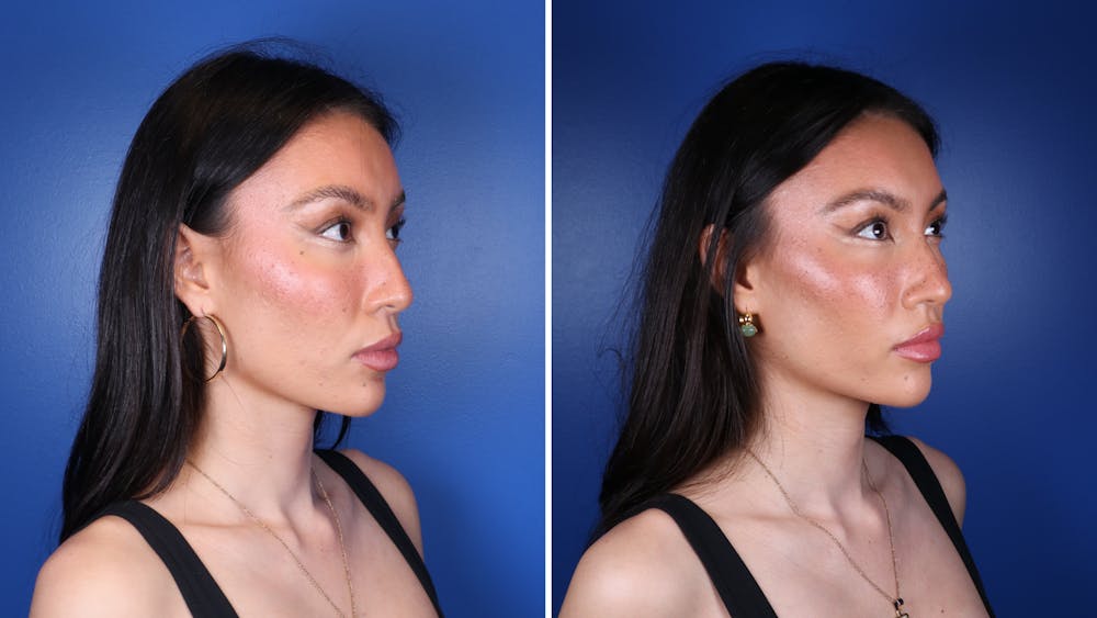 Dermal Fillers Before & After Gallery - Patient 241629 - Image 2