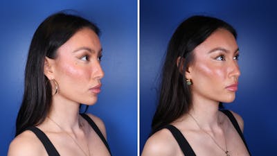 Dermal Fillers Before & After Gallery - Patient 241629 - Image 2