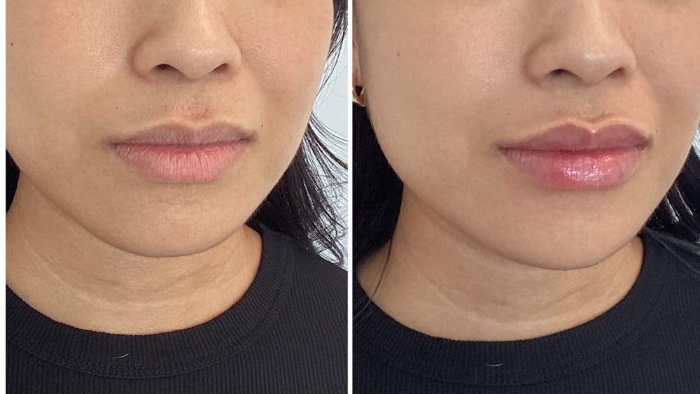 Lip Filler Before & After Gallery - Patient 150726 - Image 1