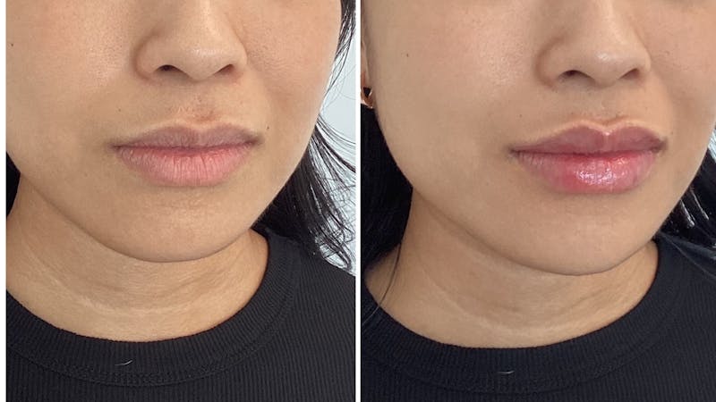 Lip fillers before & after