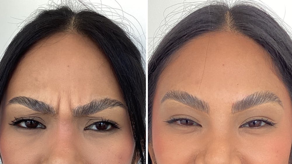 BOTOX/Daxxify Before & After Gallery - Patient 814690 - Image 1